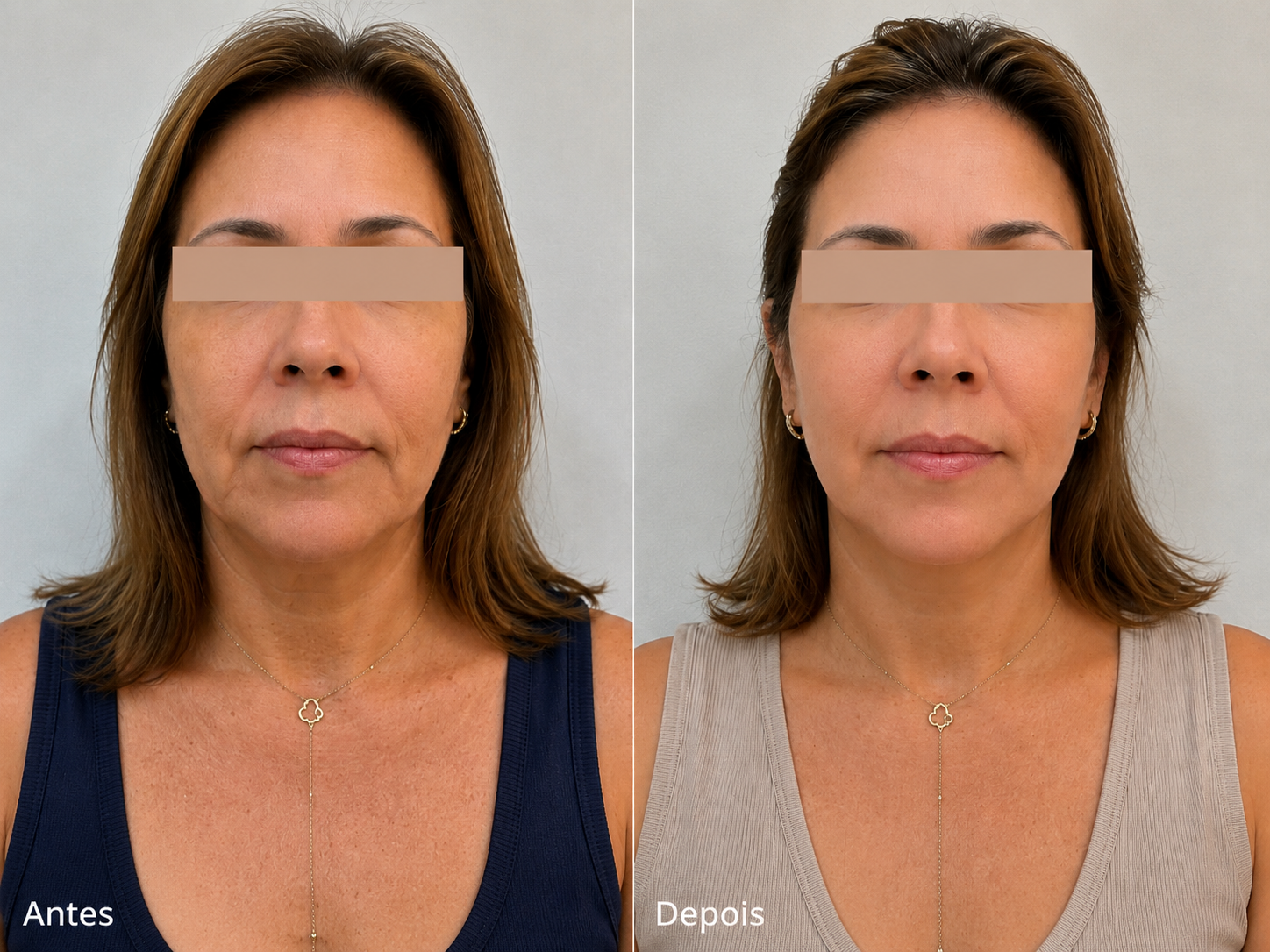 Antes e depois de harmonização do terço médio da face