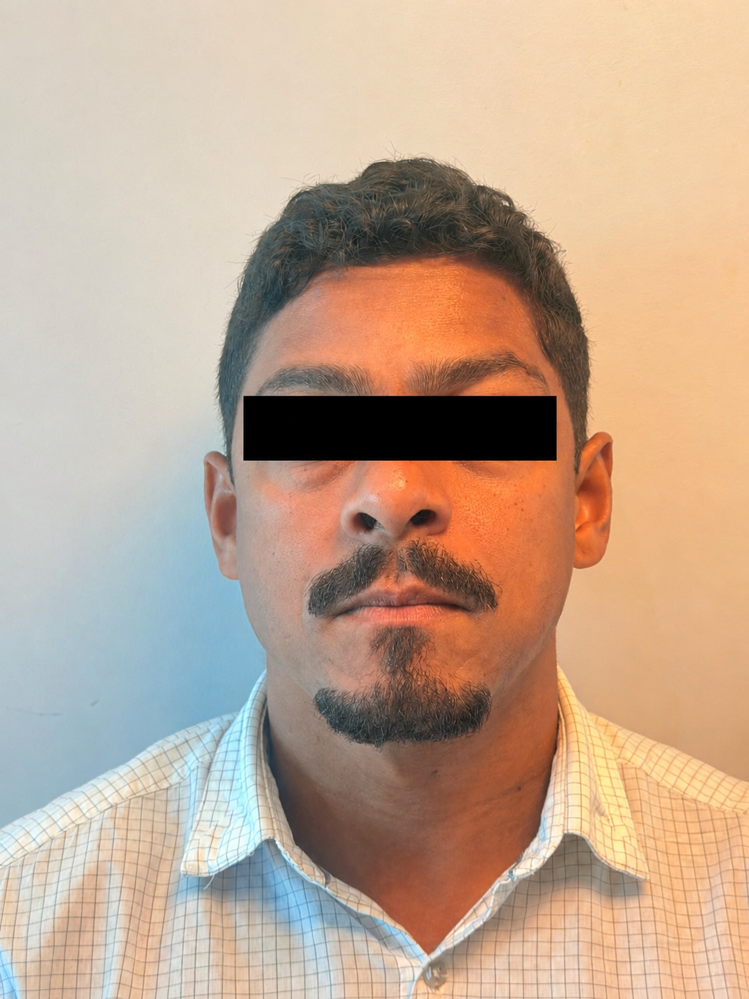 Depois do tratamento de linhas de expressão da testa