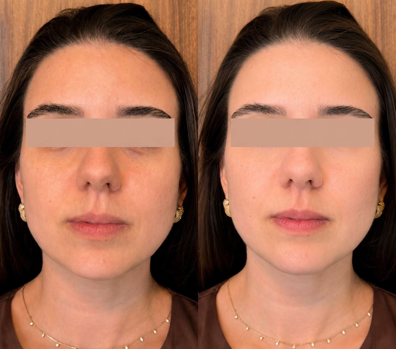 Antes e depois de tratamento de olheiras